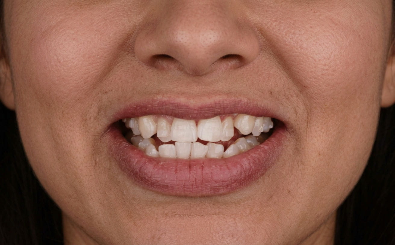 Smile after treatment